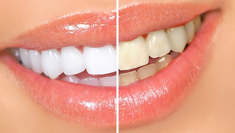 Blanqueamiento dental