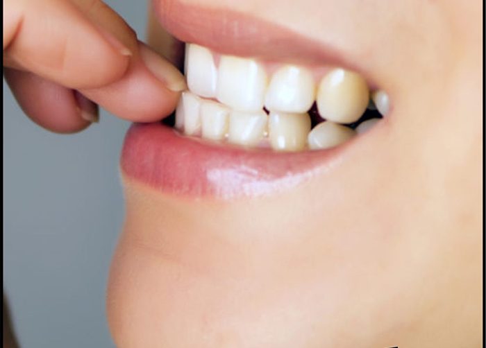 3 Hábitos que pueden dañar tu sonrisa y como evitarlo