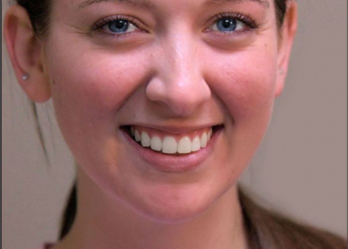 ¿Porqué se mueven los dientes después del tratamiento de ortodoncia?