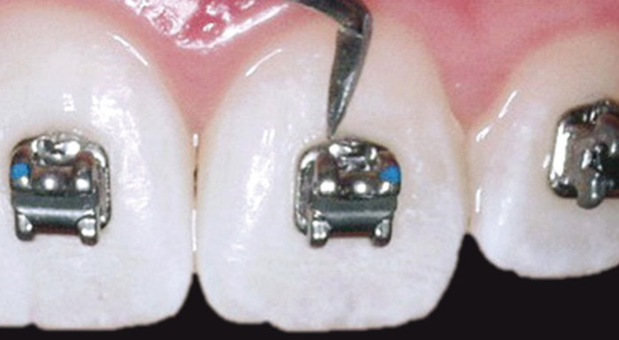 Descubre cómo colocamos los brackets en Clínica Dental Kaizen