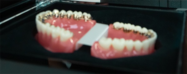 Braquets Incógnito Ortodoncia Marbella
