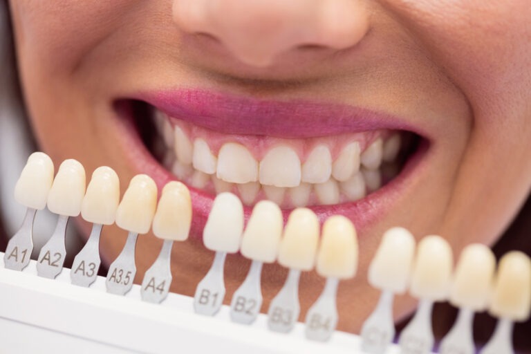 Blanqueamiento Dental Profesional Kaizen